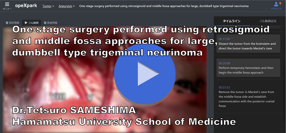 One-stage surgery performed using retrosigmoid and middle fossa approaches for large, dumbbell type trigeminal neurinoma