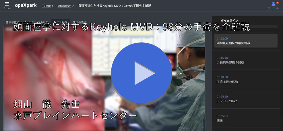 顔面痙攣に対するKeyhole MVD：98分の手術を全解説_キャプチャ