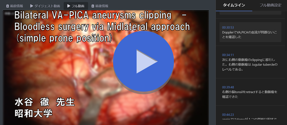 「Bilateral VA-PICA aneurysms clipping   -  Bloodless surgery via Midlateral approach(simple prone position)」