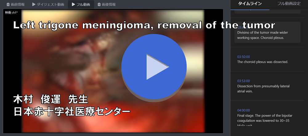 Left trigone meningioma, removal of the tumor｜日本赤十字社医療センター 木村 俊運先生 