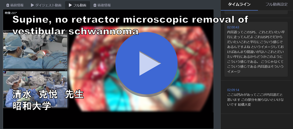 Supine, no retractor microscopic removal of vestibular schwannoma  昭和大学 清水克悦 先生