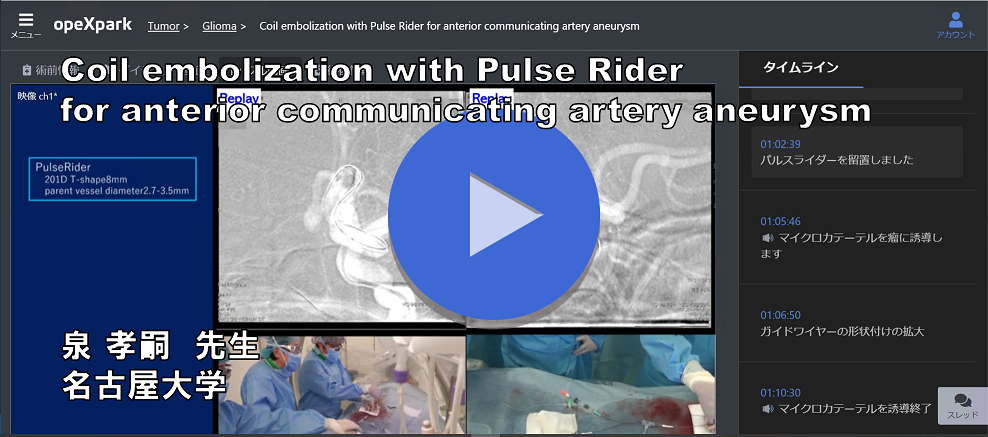 Coil embolization with Pulse Rider for anterior communicating artery aneurysm