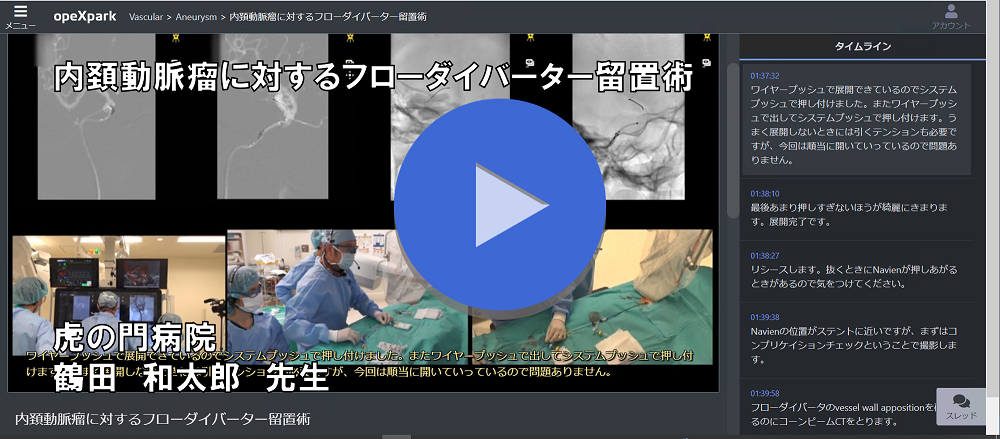 「内頚動脈瘤に対するフローダイバーター留置術」 