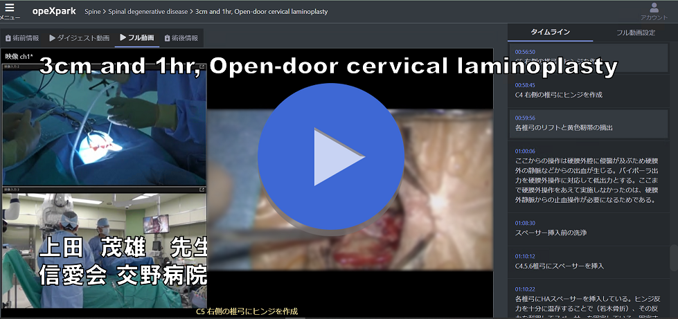 3cm and 1hr, Open-door cervical laminoplasty