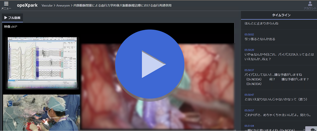 内頚動脈閉塞による血行力学的後大脳動脈瘤治療における血行再建併用