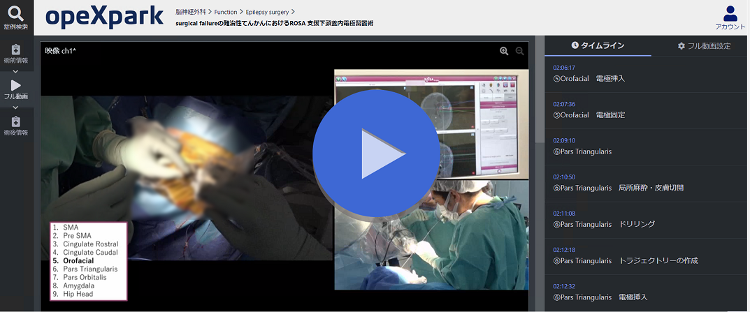 surgical failureの難治性てんかんにおけるROSA 支援下頭蓋内電極留置術の画像