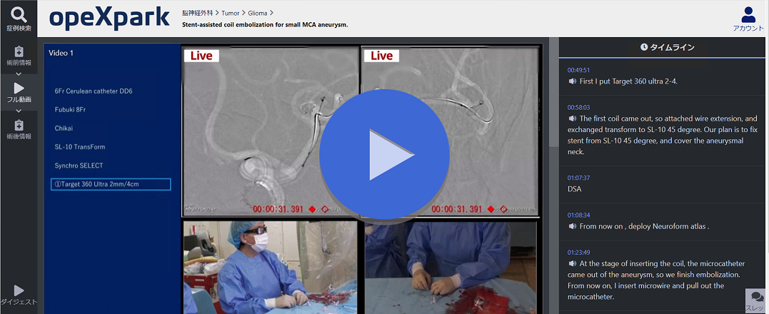 Stent-assisted coil embolization for small MCA aneurysm.の画像