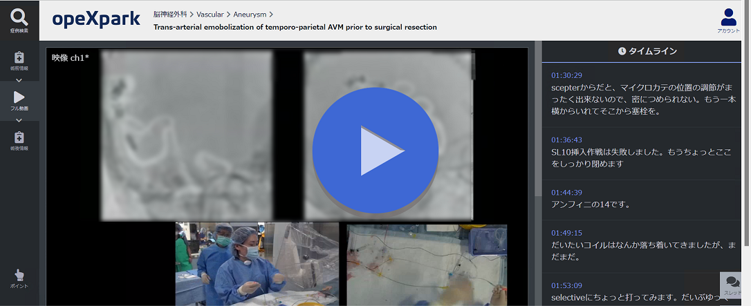 「Trans-arterial emobolization of temporo-parietal AVM prior to surgical resection」のサムネイル