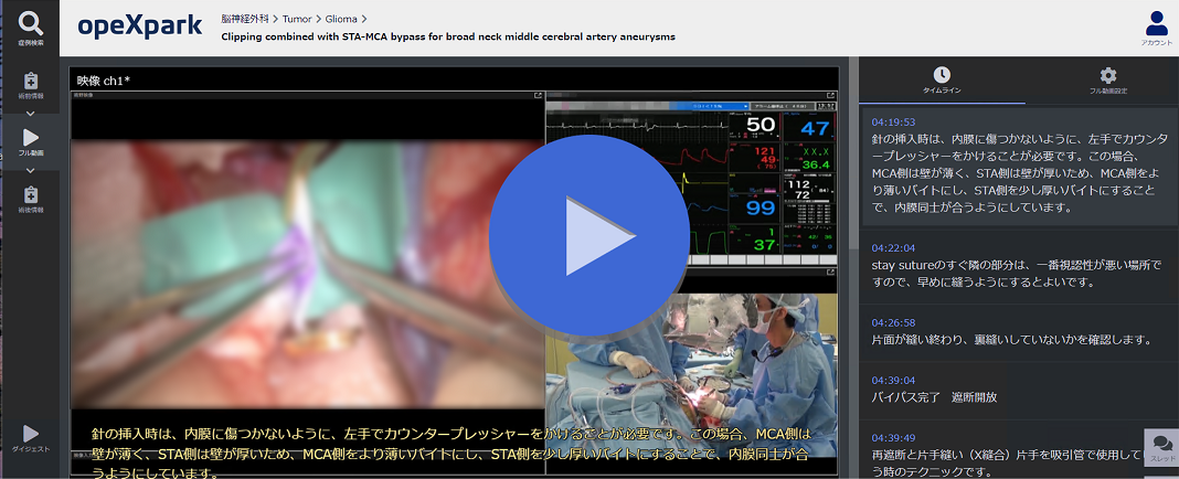 「Clipping combined with STA-MCA bypass for broad neck middle cerebral artery aneurysms」の画像