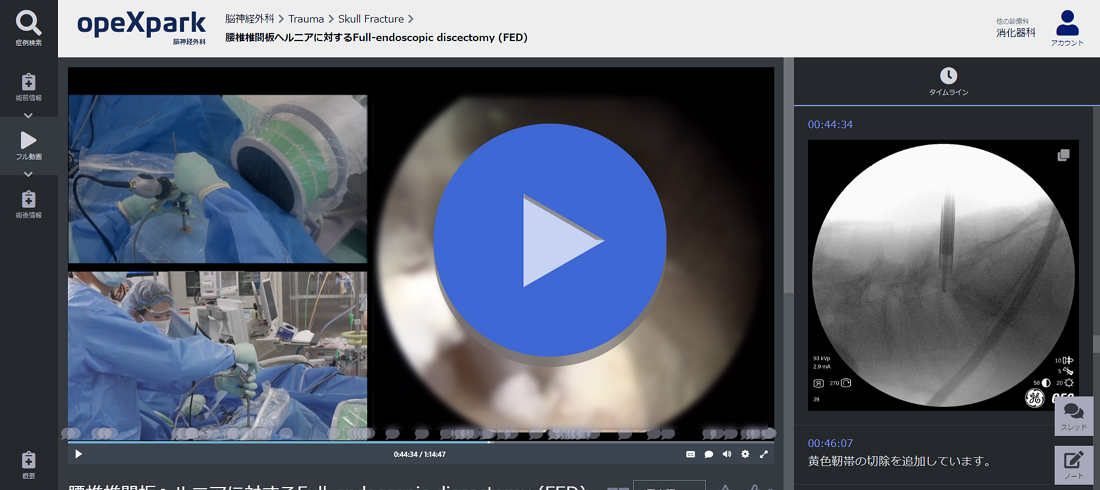 腰椎椎間板ヘルニアに対するFull-endoscopic discectomy (FED)のサムネイル画像