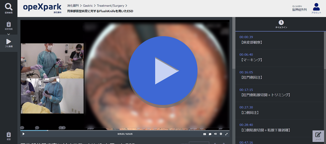 「胃体部前壁病変に対するFlushKnifeを用いたESD」のサムネイル画像