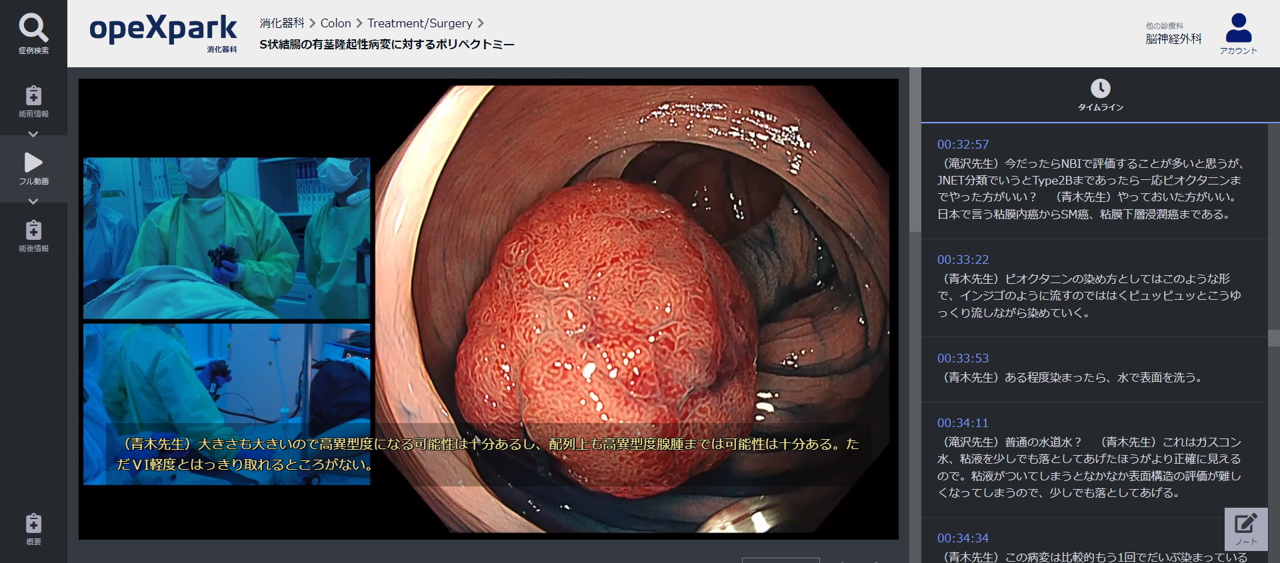 「S状結腸の有茎隆起性病変に対するポリペクトミー」のサムネイル画像