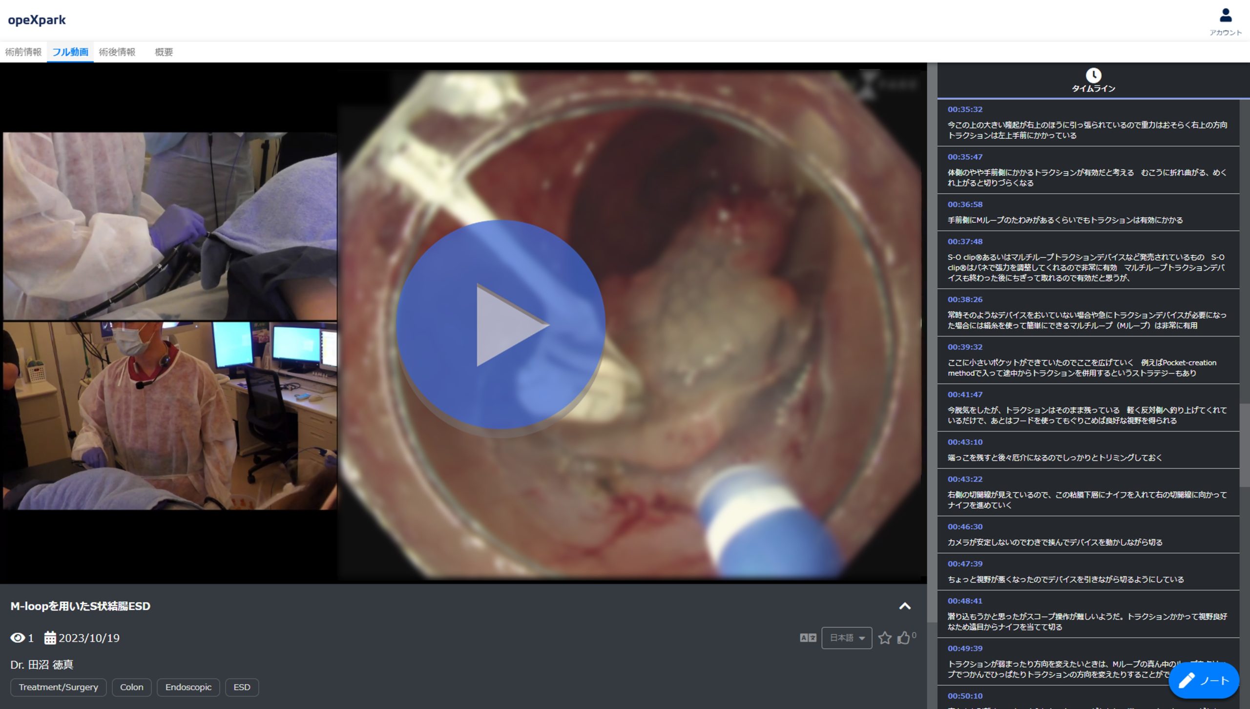 「M-loopを用いたS状結腸ESD」のサムネイル画像