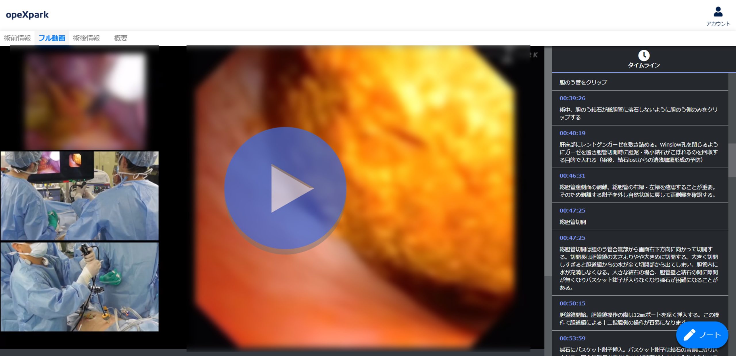 「胃がん術後（Billroth Ⅱ再建）総胆管結石に対する総胆管切石術」のサムネイル画像