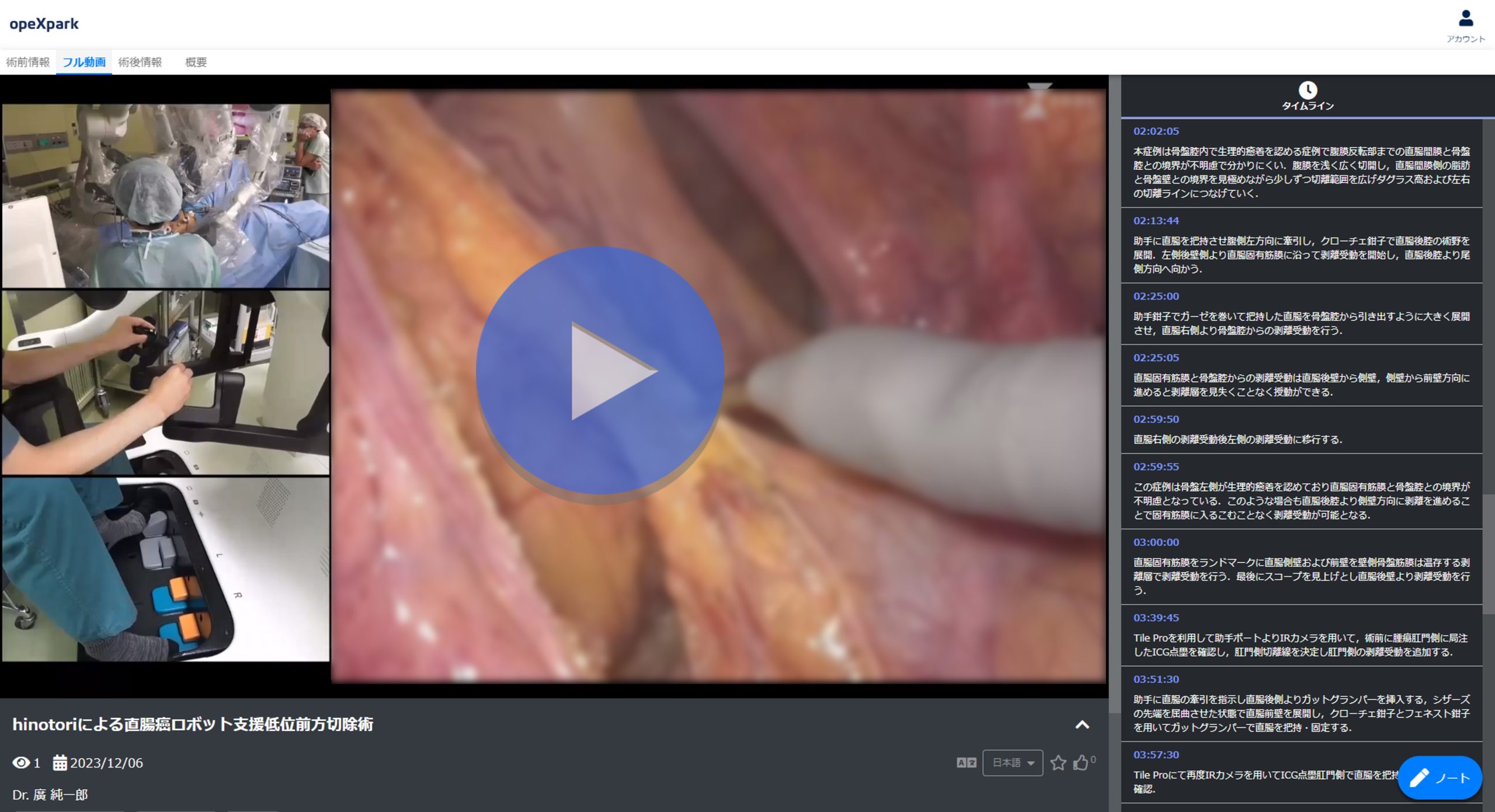 「hinotoriによる直腸癌ロボット支援低位前方切除術」のサムネイル画像