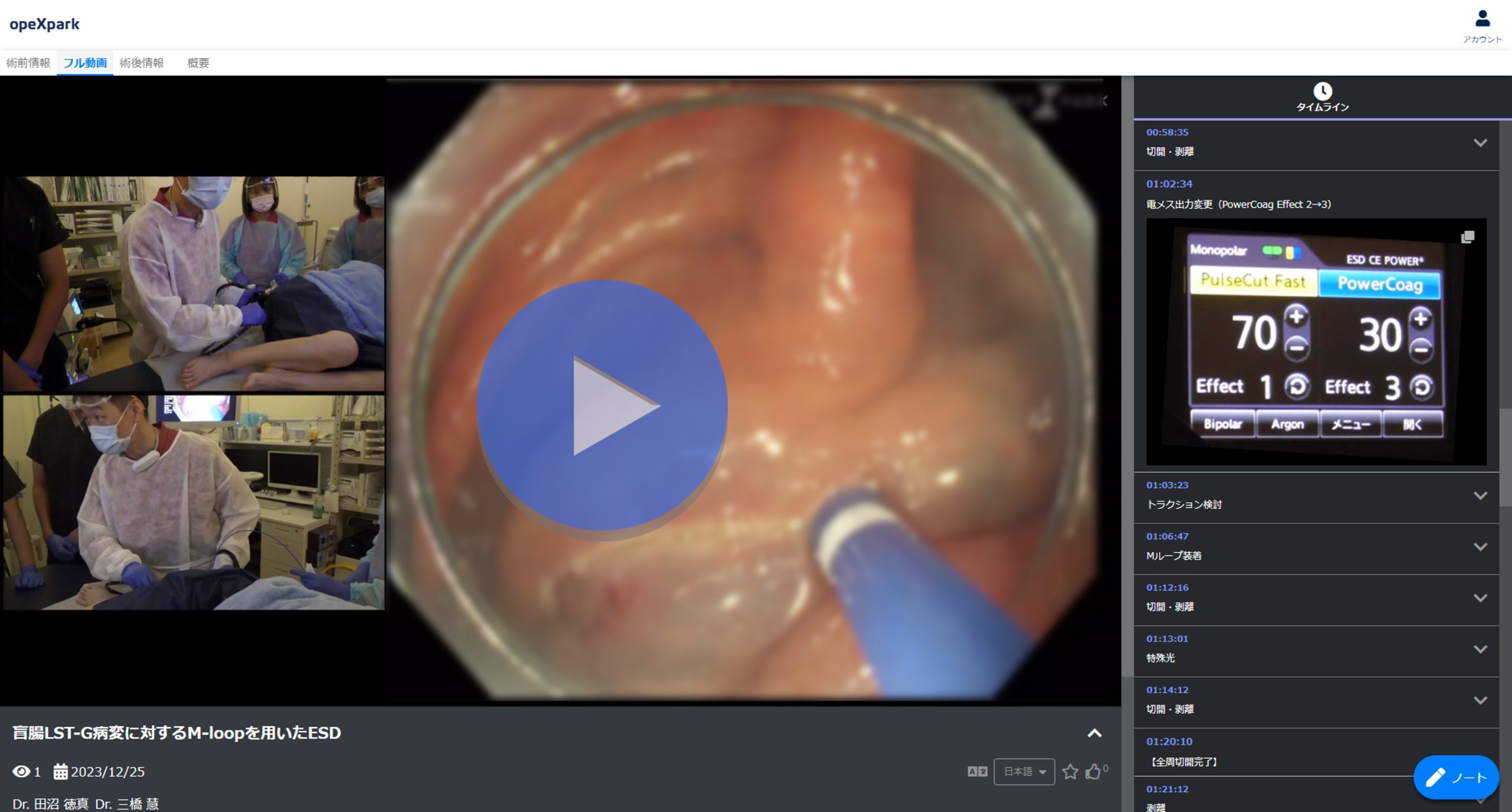 「盲腸LST-G病変に対するM-loopを用いたESD」のサムネイル画像
