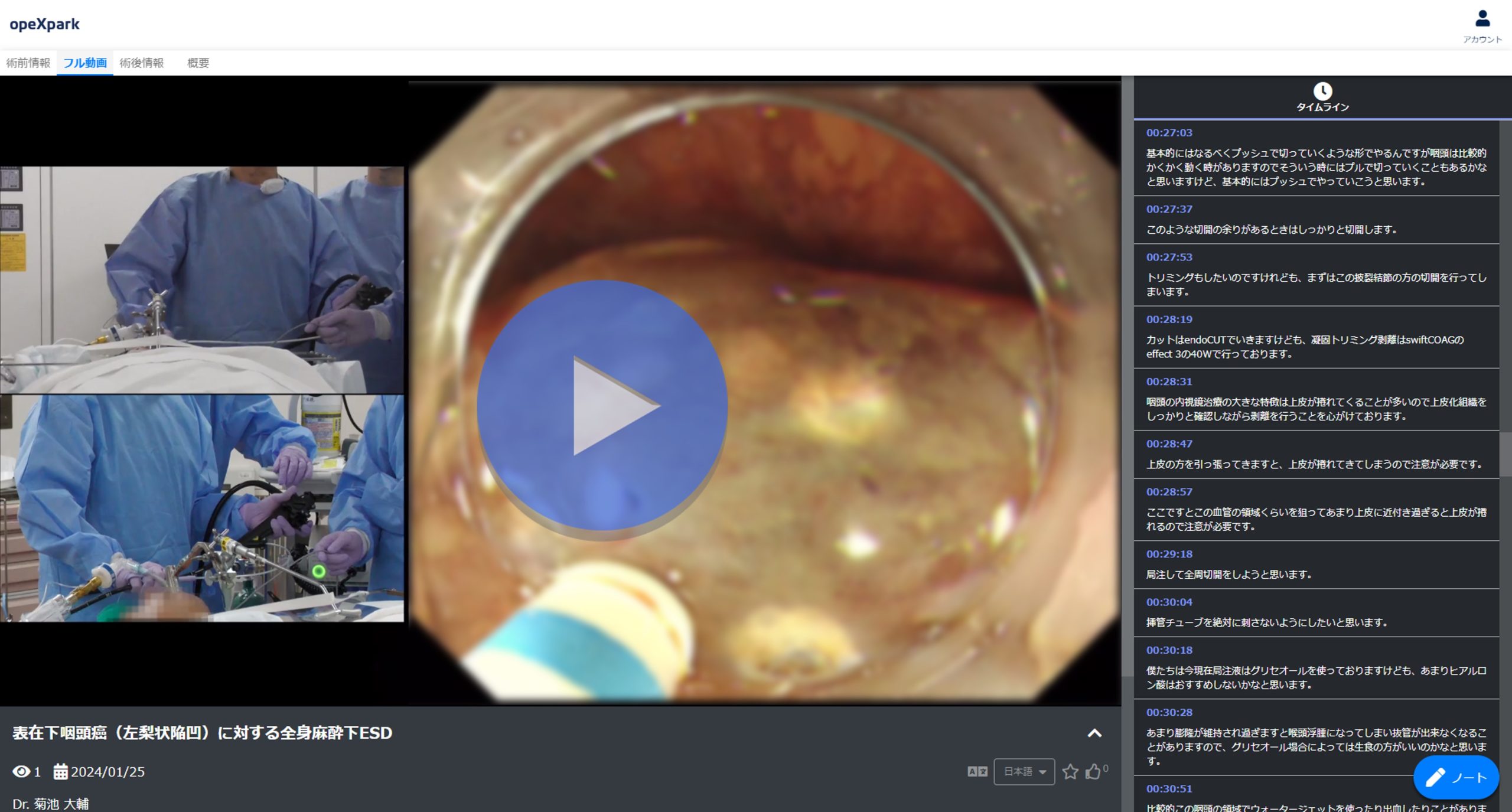 「表在下咽頭癌（左梨状陥凹）に対する全身麻酔下ESD」のサムネイル画像