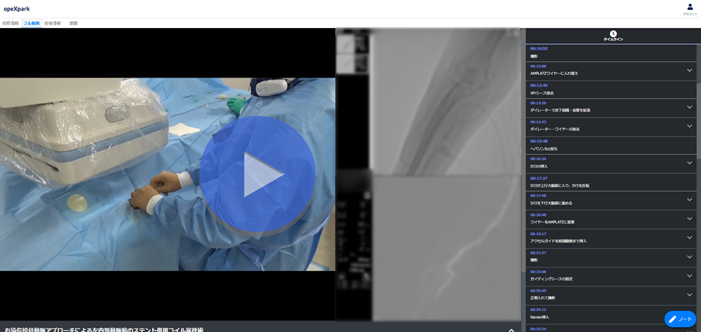 「右遠位橈骨動脈アプローチによる左内頚動脈瘤のステント併用コイル塞栓術」のサムネイル画像