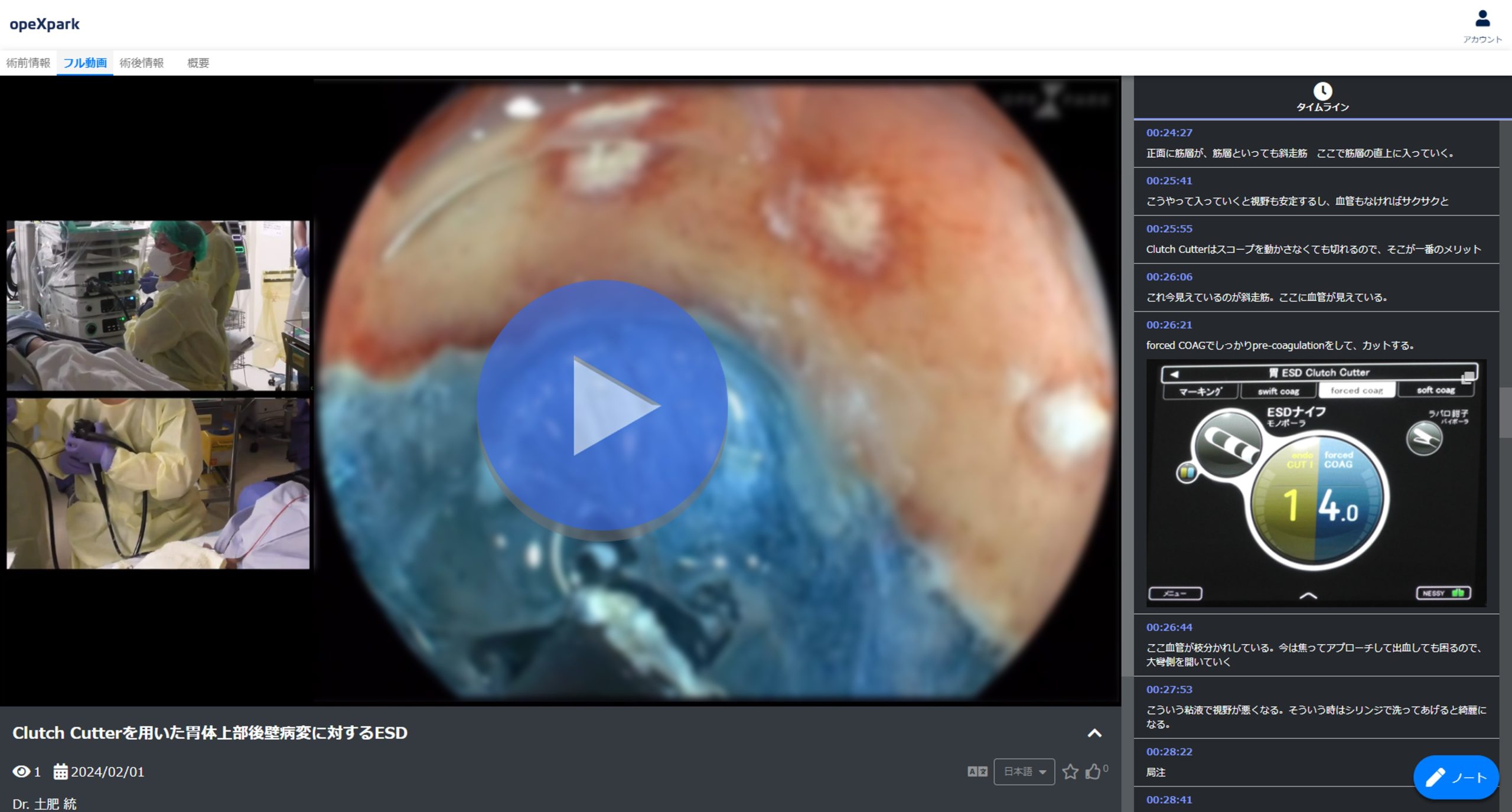 「Clutch Cutterを用いた胃体上部後壁病変に対するESD」のサムネイル画像