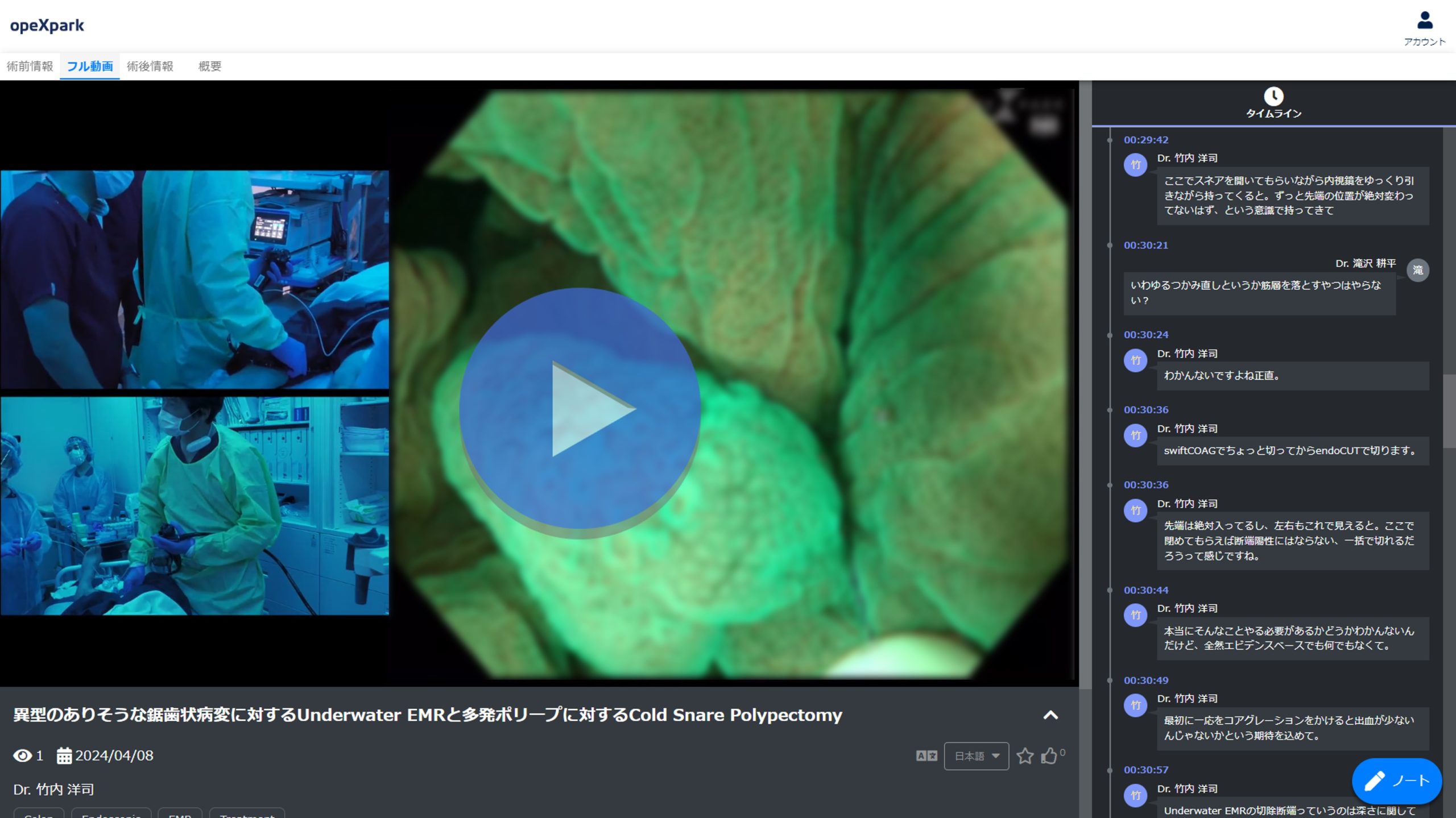 「異型のありそうな鋸歯状病変に対するUnderwater EMRと多発ポリープに対するCold Snare Polypectomy」のサムネイル画像