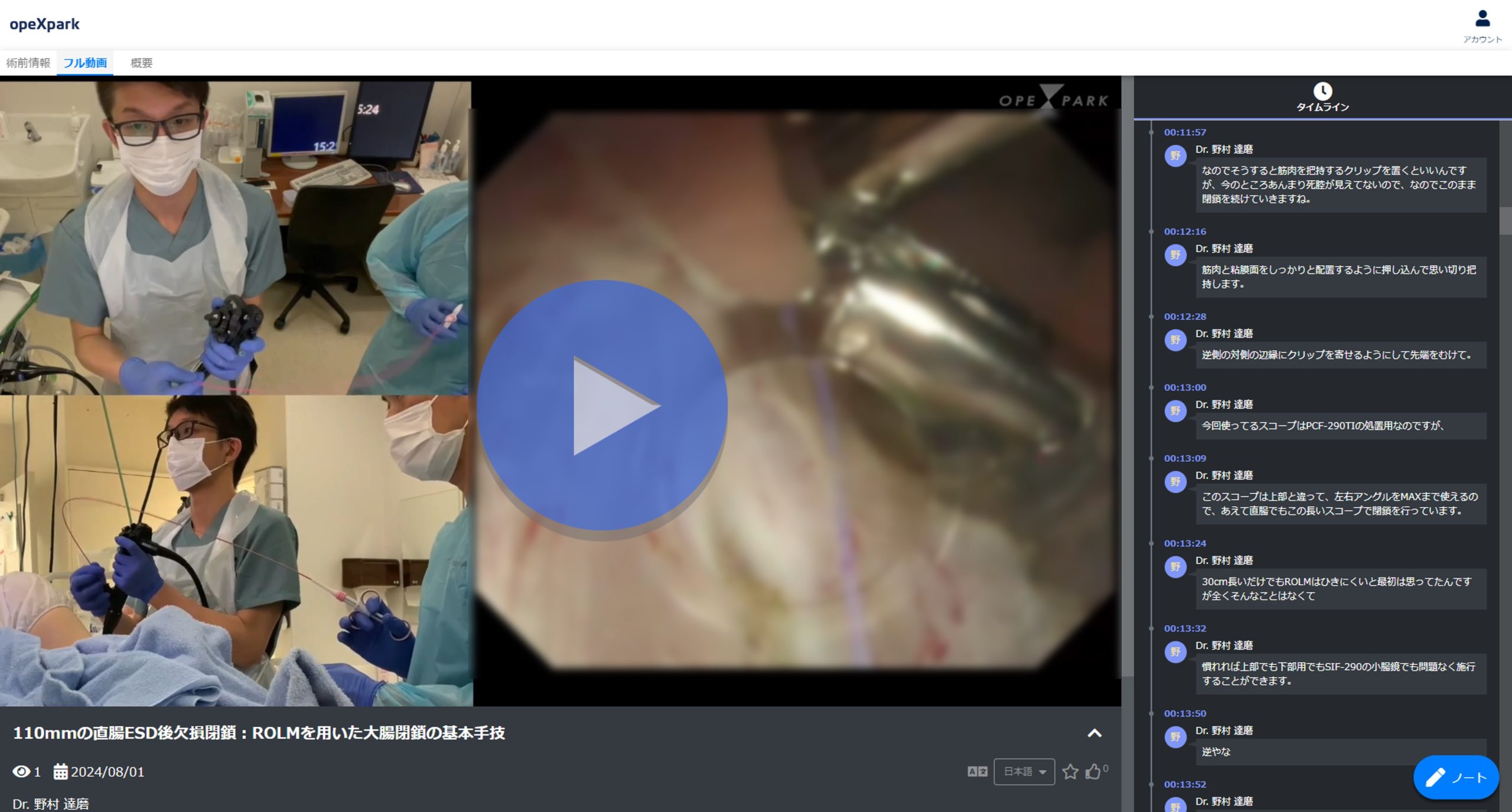 「110mmの直腸ESD後欠損閉鎖：ROLMを用いた大腸閉鎖の基本手技」のサムネイル画像