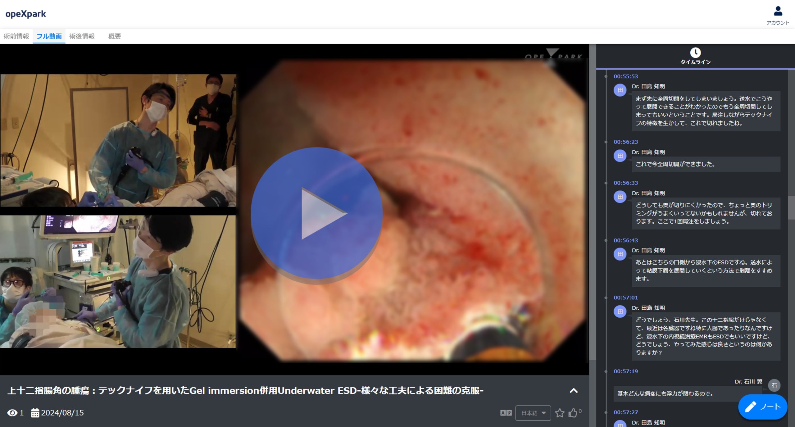 「上十二指腸角の腫瘍：テックナイフを用いたGel immersion併用Underwater ESD-様々な工夫による困難の克服-」のサムネイル画像