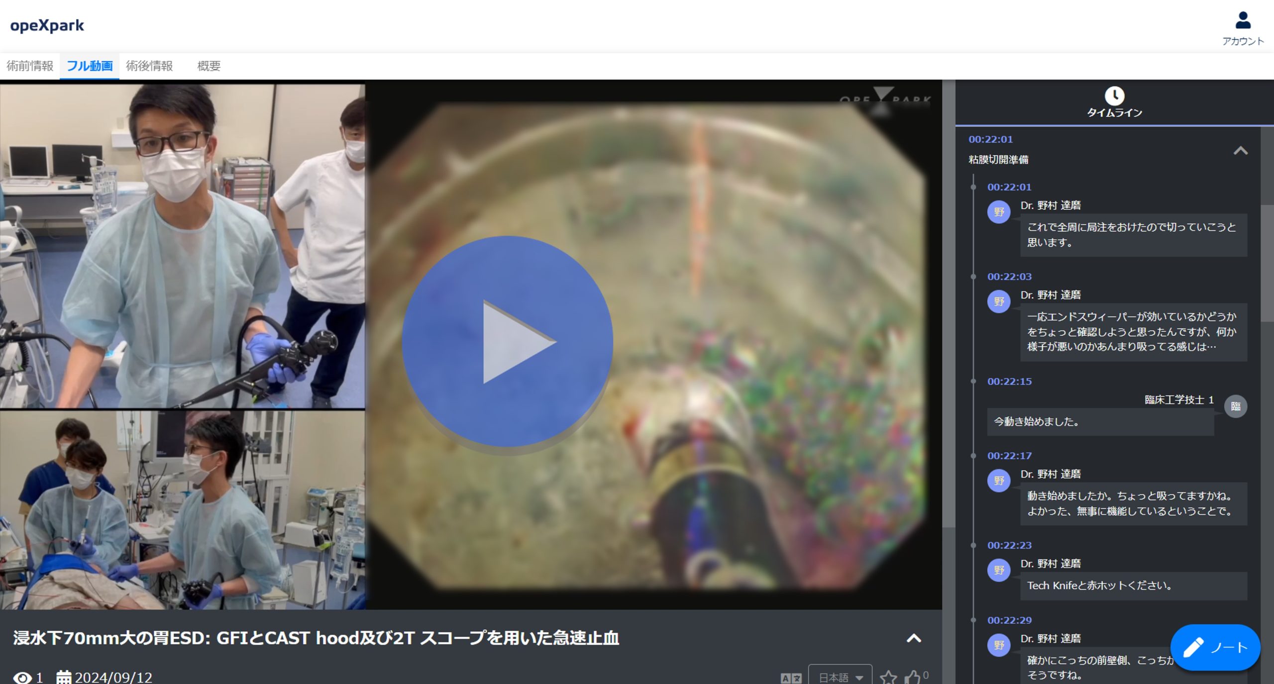 「浸水下70mm大の胃ESD: GFIとCAST hood及び2T スコープを用いた急速止血」のサムネイル画像