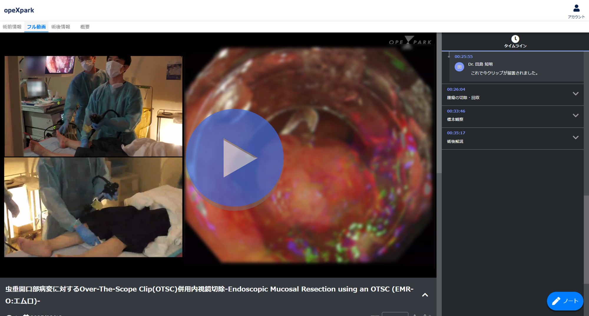 「虫垂開口部病変に対するOver-The-Scope Clip(OTSC)併用内視鏡切除-Endoscopic Mucosal Resection using an OTSC (EMR-O:エムロ)-」のサムネイル画像
